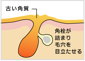 膨らんだ毛穴の原因