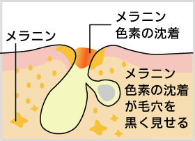 黒ずんだ毛穴の原因