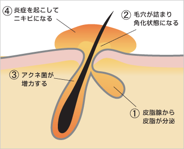 ニキビのメカニズム